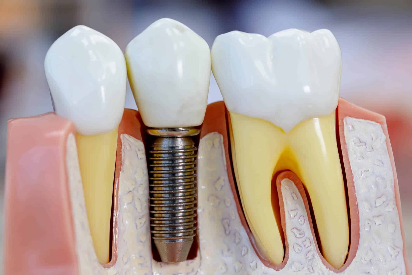 Implantes Dentários em Goiânia